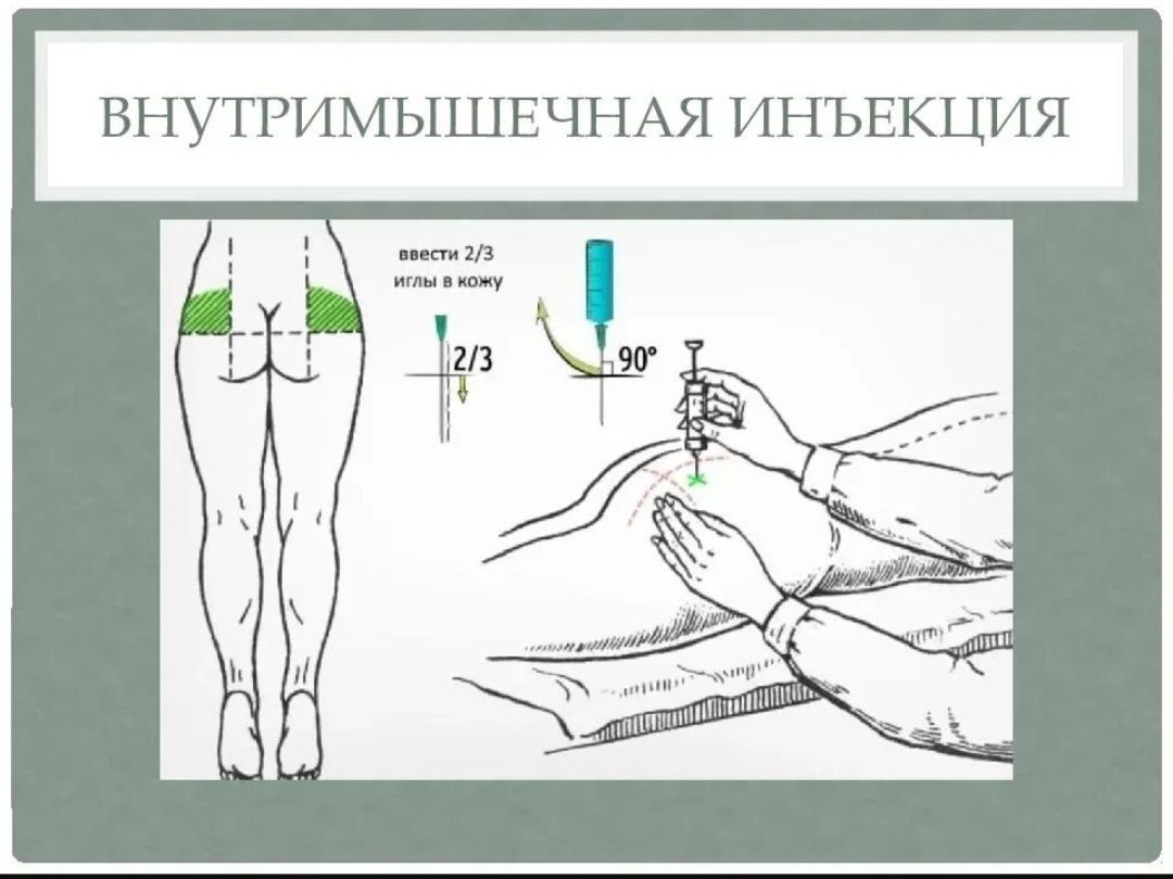 внутремышечная инъекция. из интернета