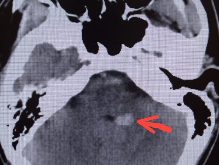 Сильное головокружение и инсульт