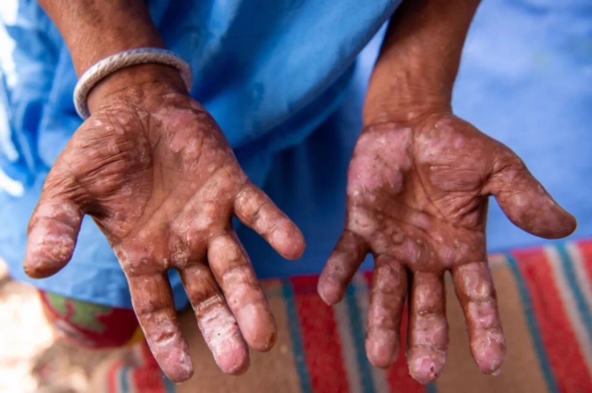    Инфекционист Никифоров оценил вероятность завоза в РФ проказы