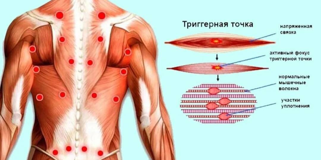 Почему боль «путешествует» по телу? Триггерные точки — скрытые источники дискомфорта и как с ними работать