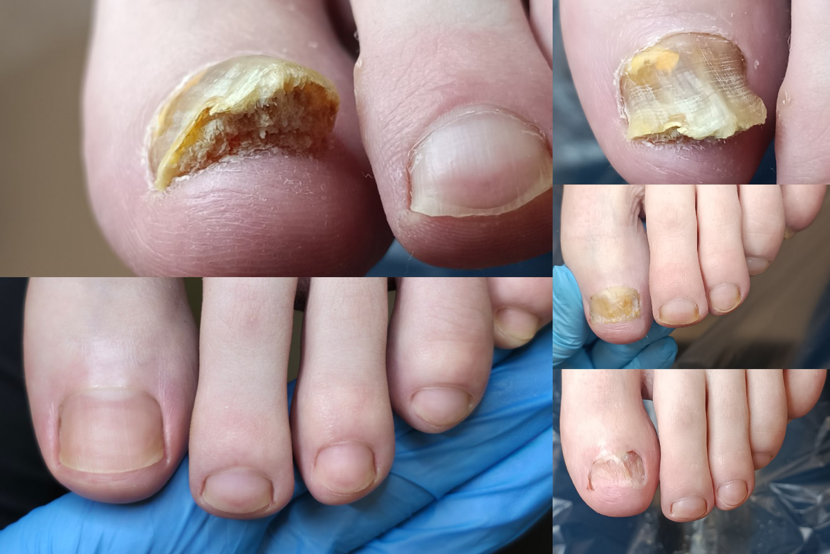 Лечение онихомикоза, результат за пол года