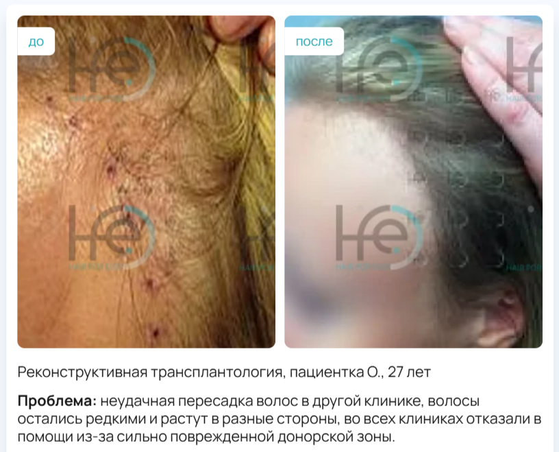 Исправление неудачной пересадки волос. Фото с сайта https://hfe-hfe.ru/