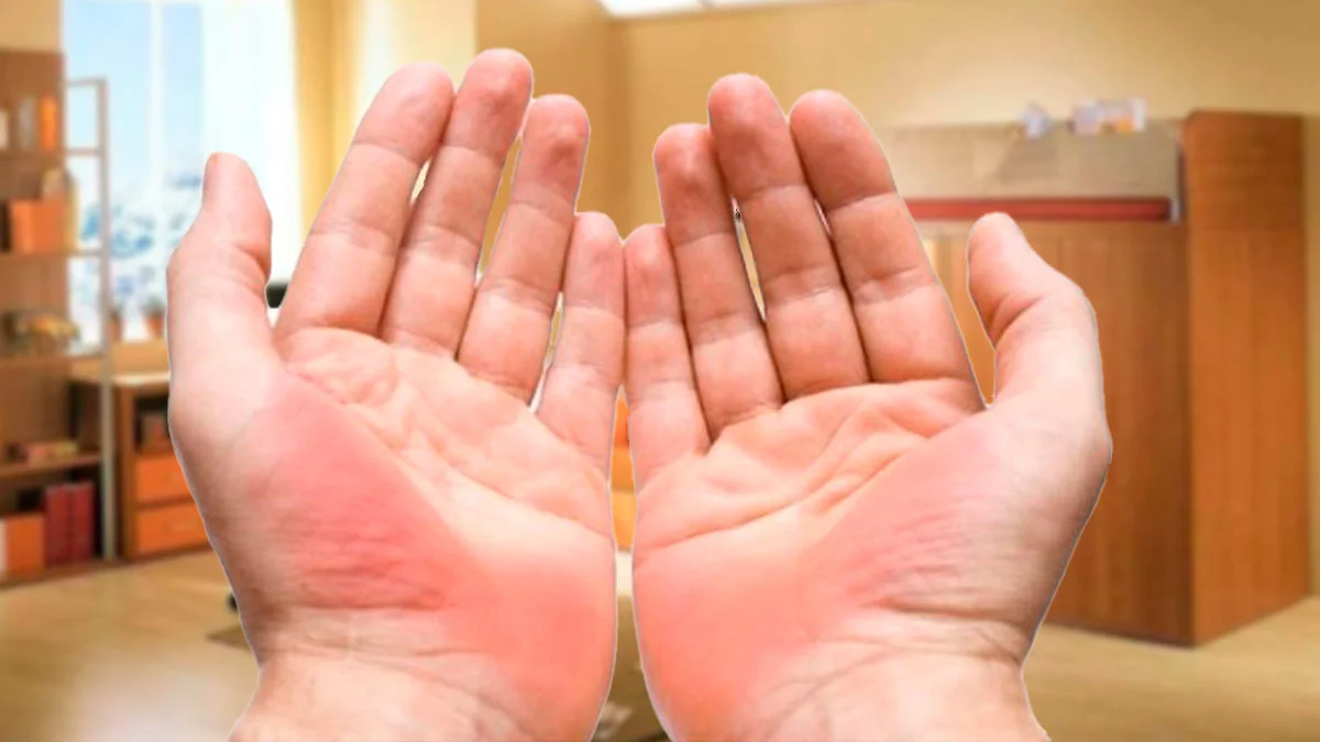 Пальмарная эритема (печеночные ладони). profile.ru