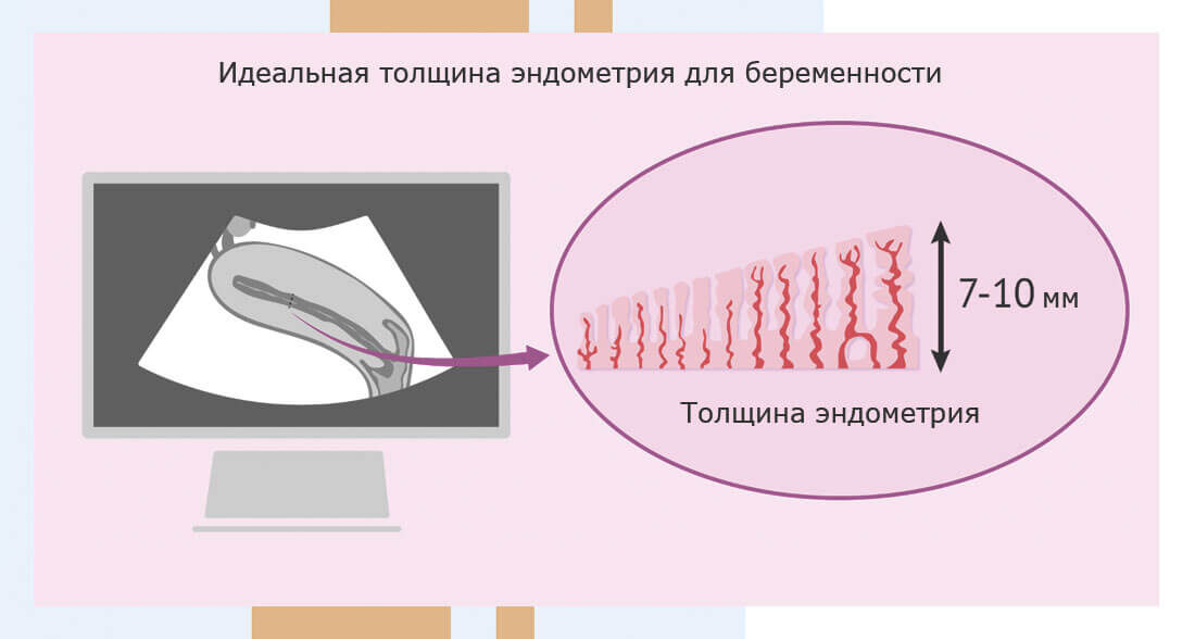 УЗ-диагностика состояния эндометрия