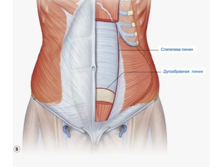 Грыжа Спигелевой линии.