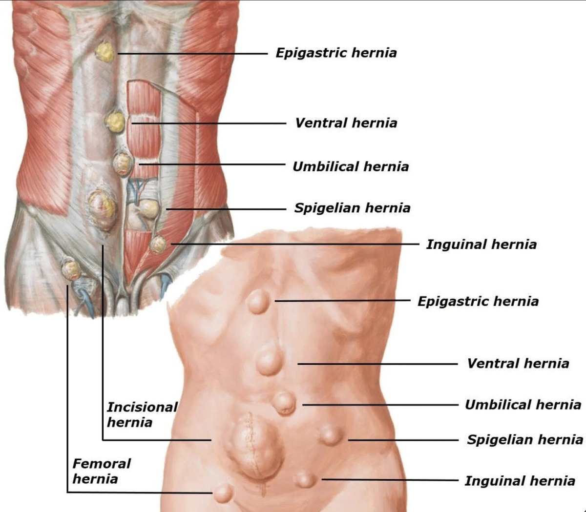 Различные виды грыж брюшной стенки. 