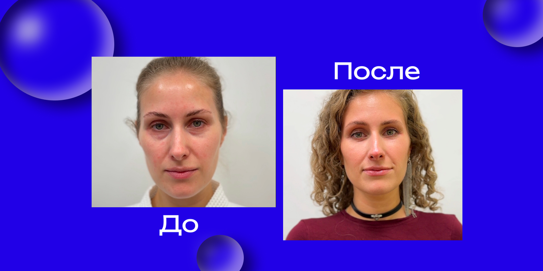 2 месяца после нижней трансконъюктивальной блефаропластики