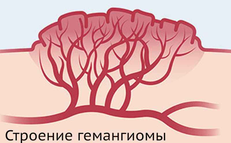 Гемангиома - сосудистое разрастание, поэтому через ее тело проходит много крови