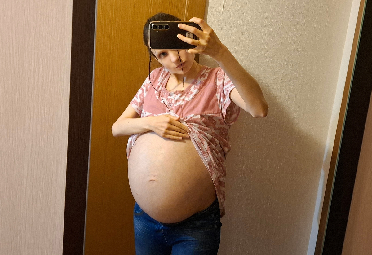 Асцит незадолго до поездки на лапароцентез