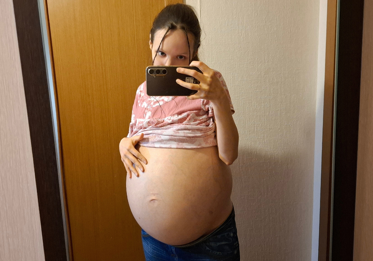 Напряженный асцит