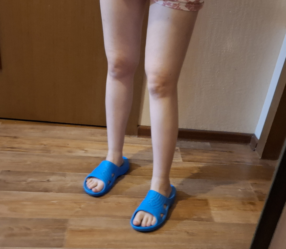 Отеки из-за огромного асцита