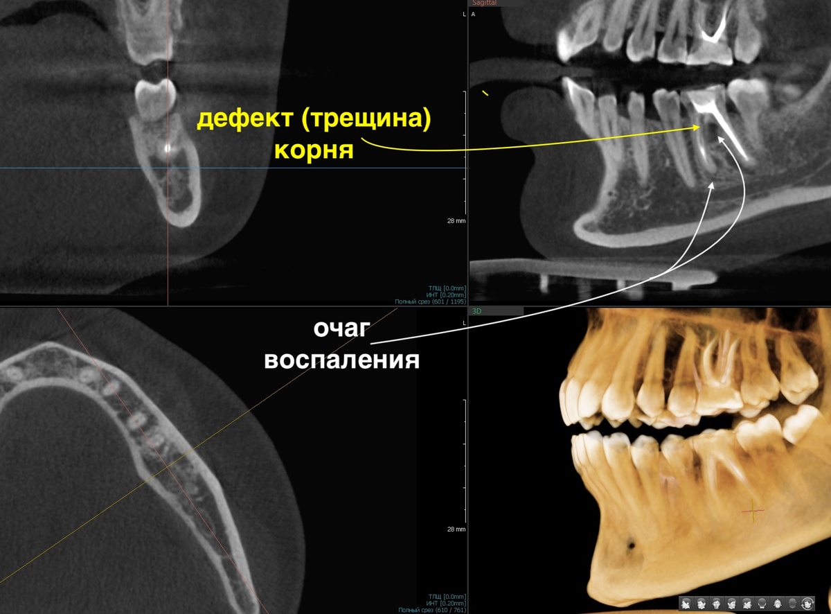 Зуб 3.6, периодонтит