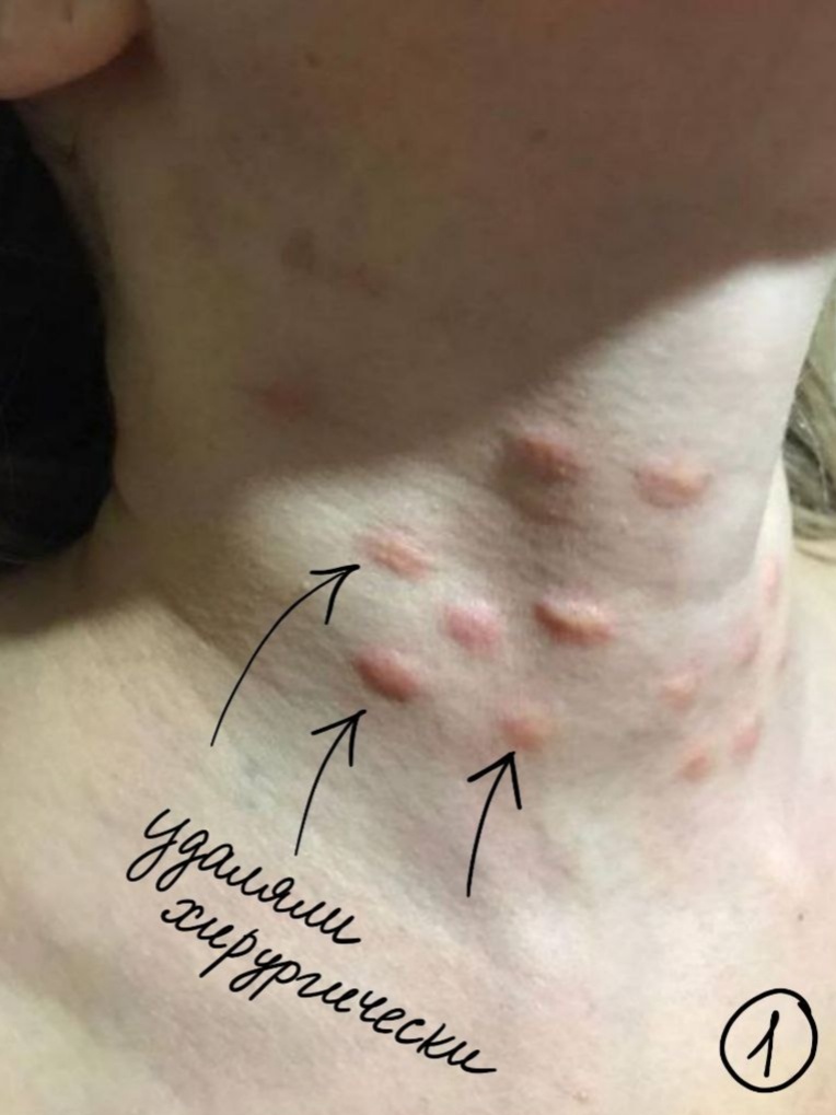 красные бугорки там, где вводили „препарат для биоревитализации“, который для нее не предназначен