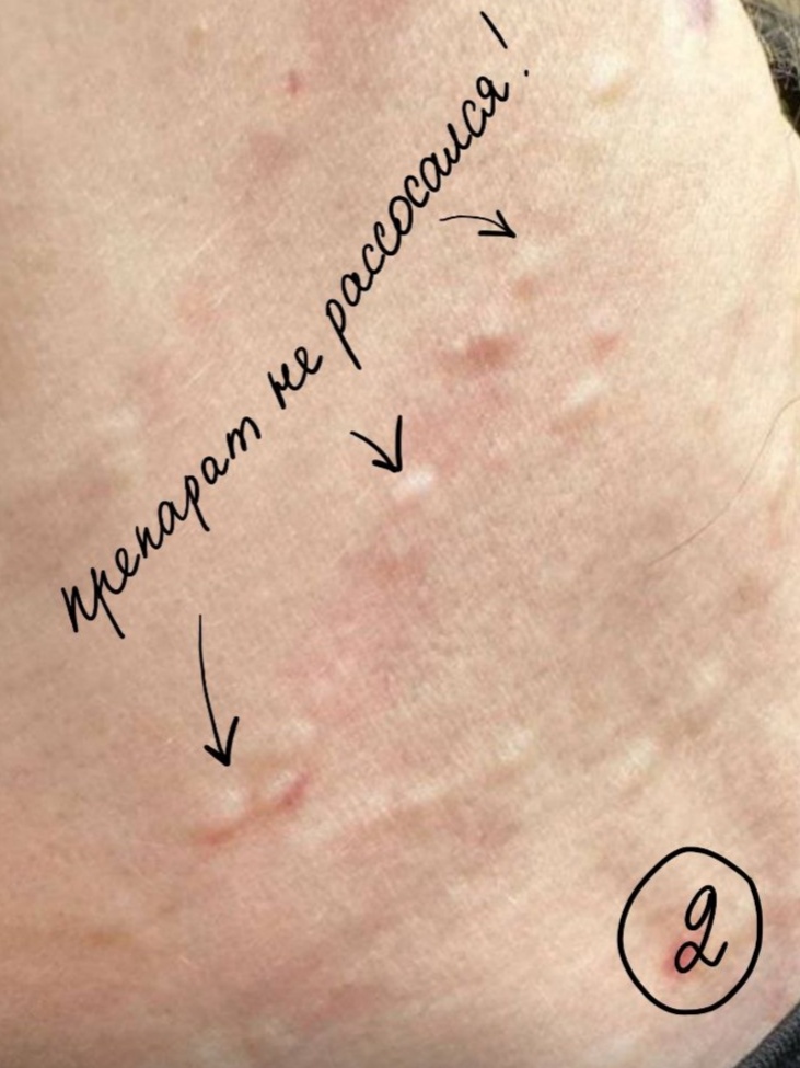 слишком плотный препарат введен, сам не рассосался