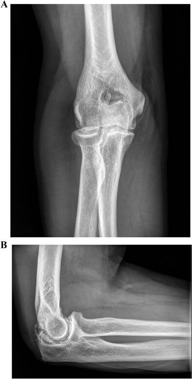 Остеоартрит локтевого сустава
