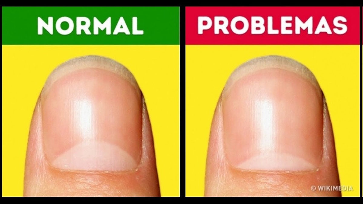 Почему ногти становятся ребристыми даже у здоровых людей