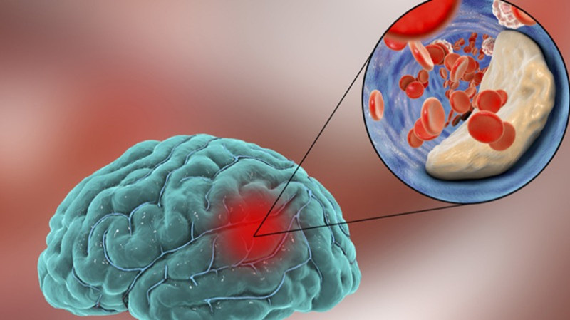 Как распознать «предупреждающий» инсульт и как на него реагировать