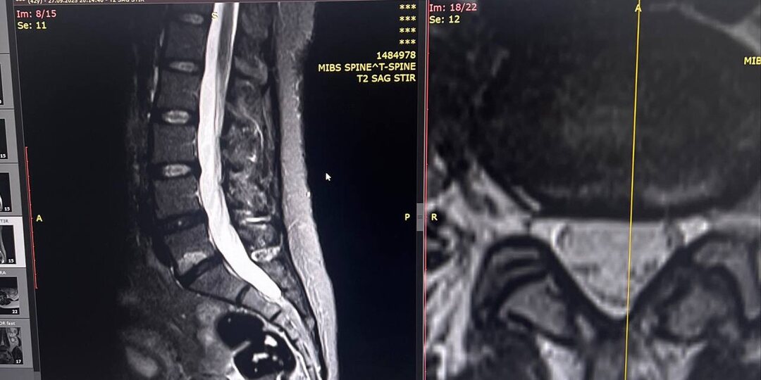 Когда МРТ показывает «воспаление» в позвонках, а врачи пожимают плечами