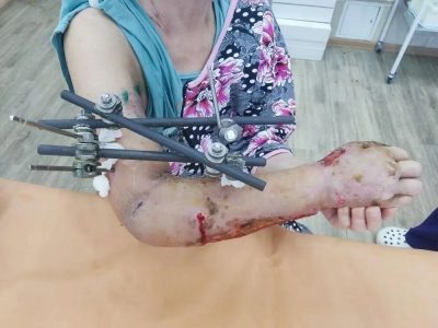 С полностью прижившейся рукой выписали из больницы женщину, ранее пострадавшую на производстве