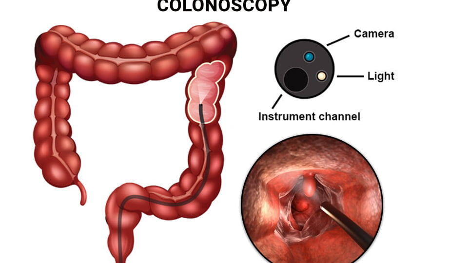 «Колоноскопия и перфорация: реальные риски vs страшилки из интернета»