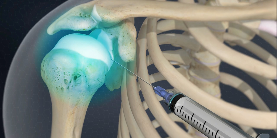 Инъекции гиалуроновой кислоты: когда «протез синовиальной жидкости» работает, а когда это деньги на ветер