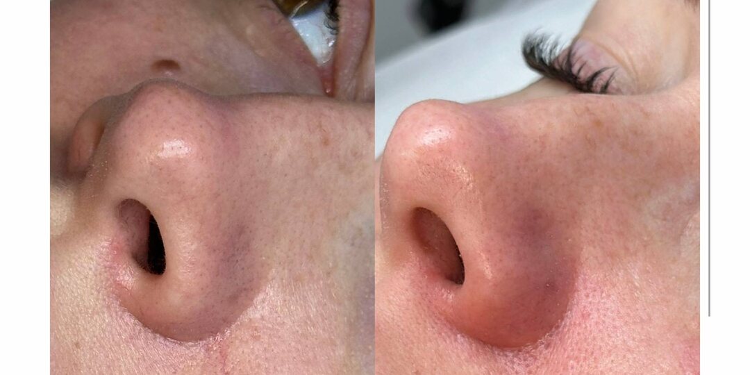 Как же происходит удаление сосудов на носу