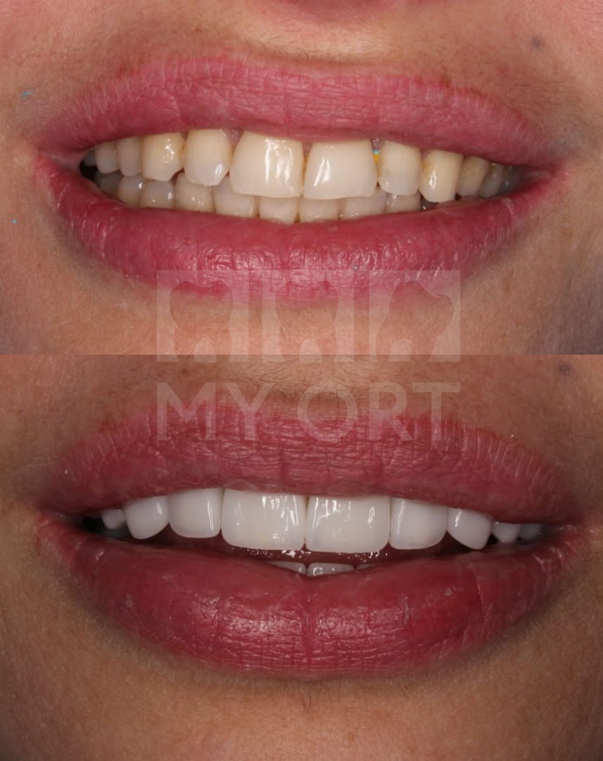 До и после лечения и установки виниров