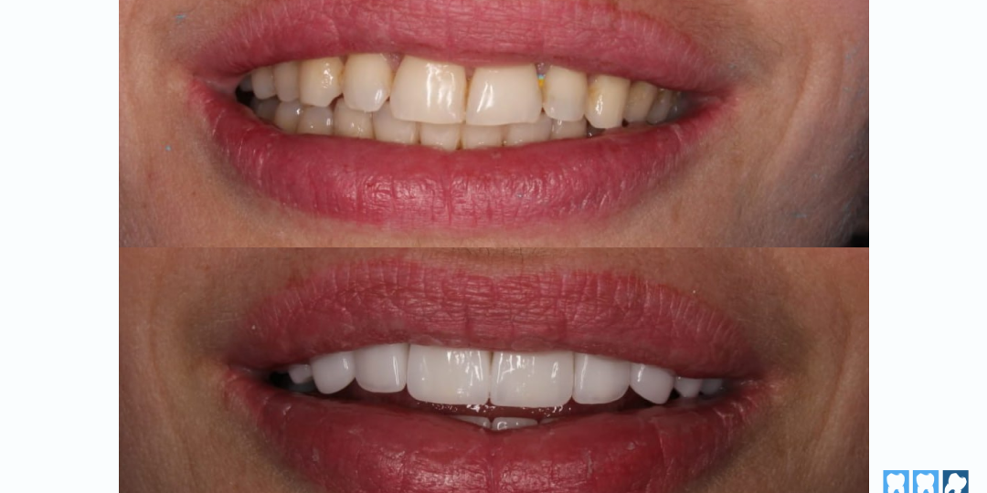 Белоснежная улыбка для пациентки. Как мы поставили виниры после ортодонтического лечения.