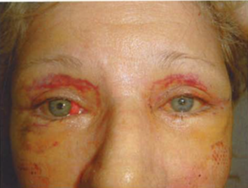 Справа видно, насколько быстро Биоптрон помог восстановиться после операции. 