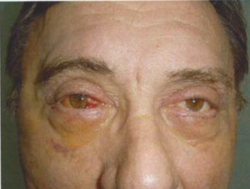 Также можно наблюдать, как на правой стороне картинки заживление прошло быстрее, благодаря технологии Биоптрон. 