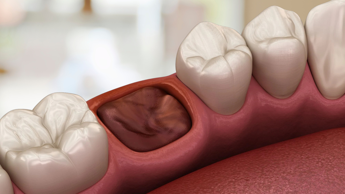 Сухая лунка