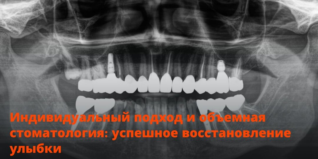 Индивидуальный подход и объемная стоматология: успешное восстановление улыбки