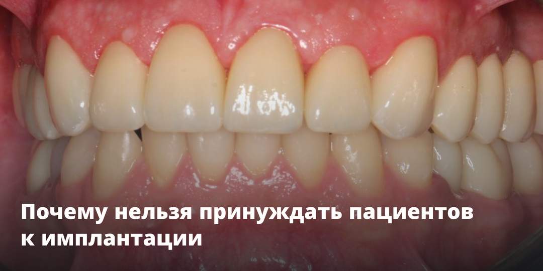 Почему нельзя принуждать пациентов к имплантации