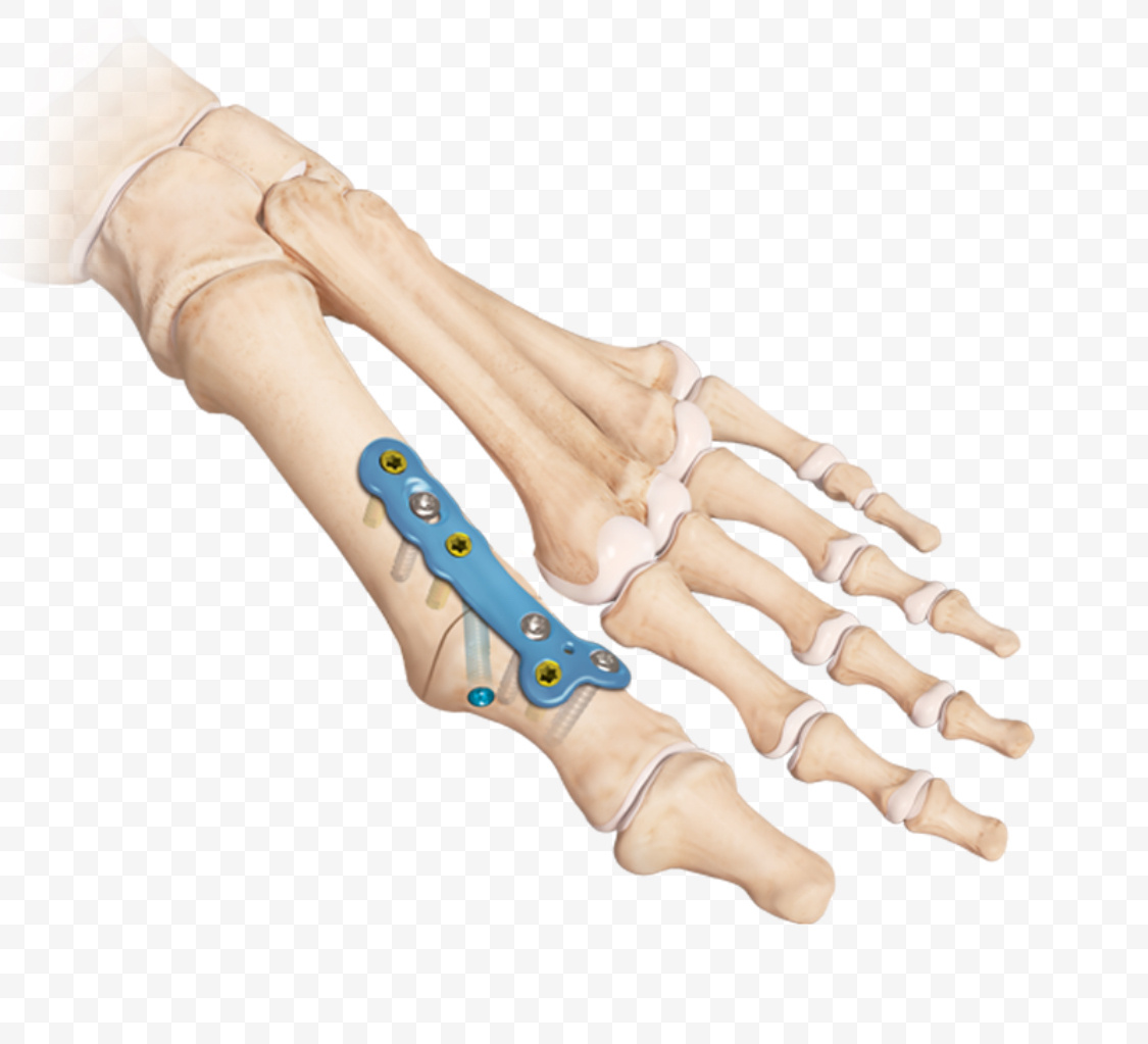 Артродез первого плюснефалангового сустава