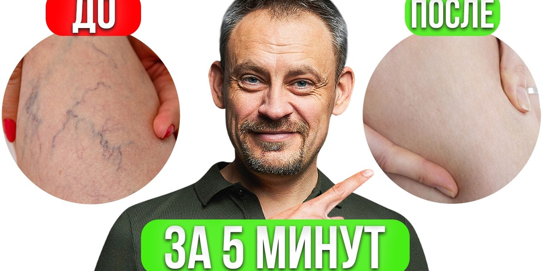 Не делай это при ВАРИКОЗЕ! Убираем варикоз ДОМА и без операций