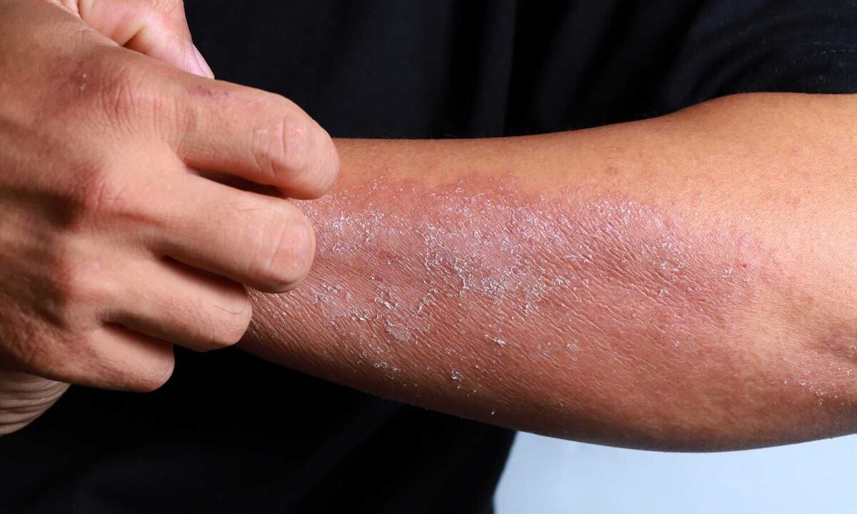 Причины псориаза: что запускает обострение на самом деле 