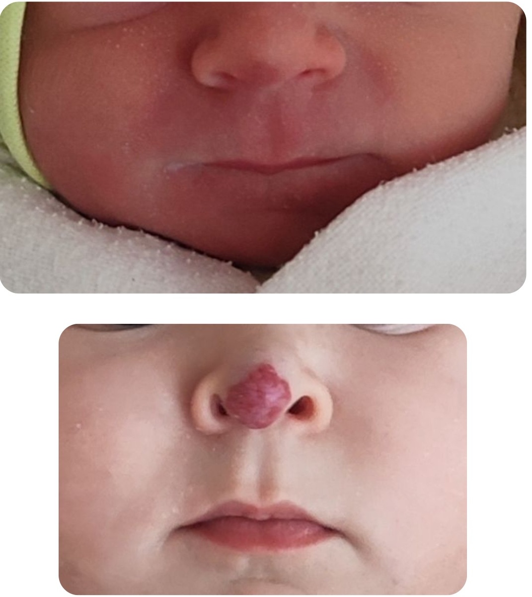 Наглядный пример внешне "безобидного" пятна на кончике носа у новорожденного (гемангиома), давшего рост в течение 4 месяцев после рождения ребенка с последующей деформацией хрящей носа. 