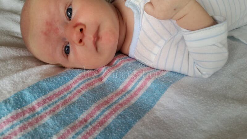 Пример невуса Унны по типу "метки ангела" с локализацией на лбу и крыльях носа 