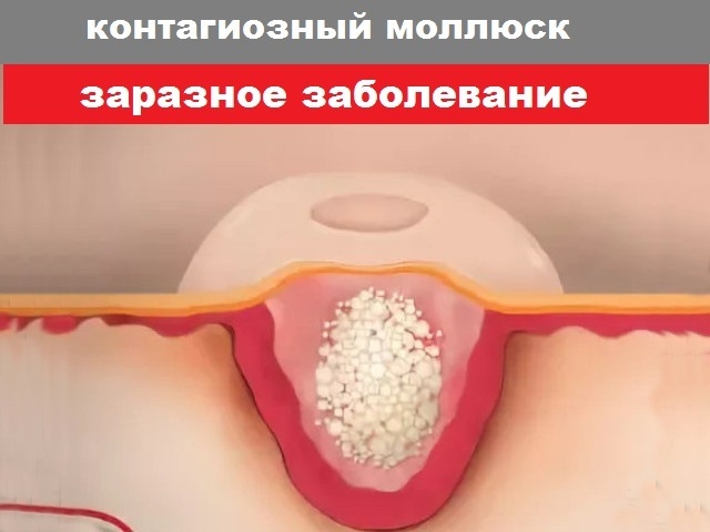 Первое лекарство от контагиозного моллюска