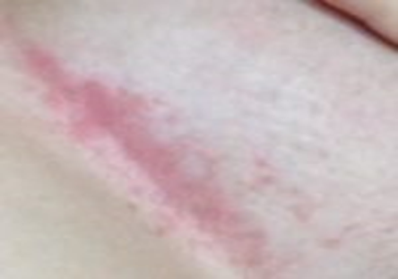 1 стадия Эритематозной опрелости
