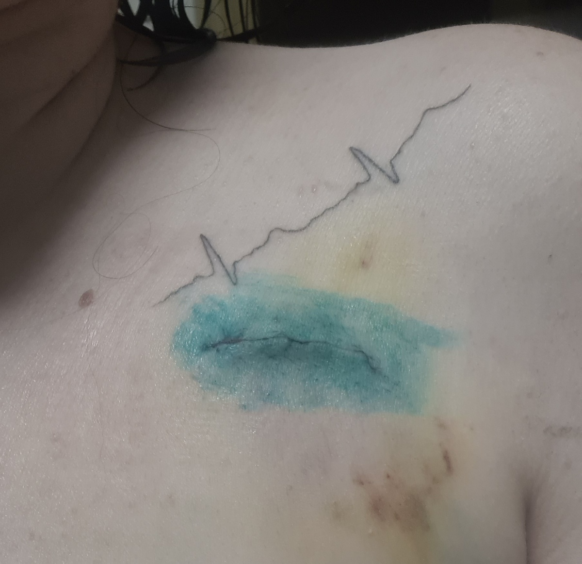 7 дней после операции