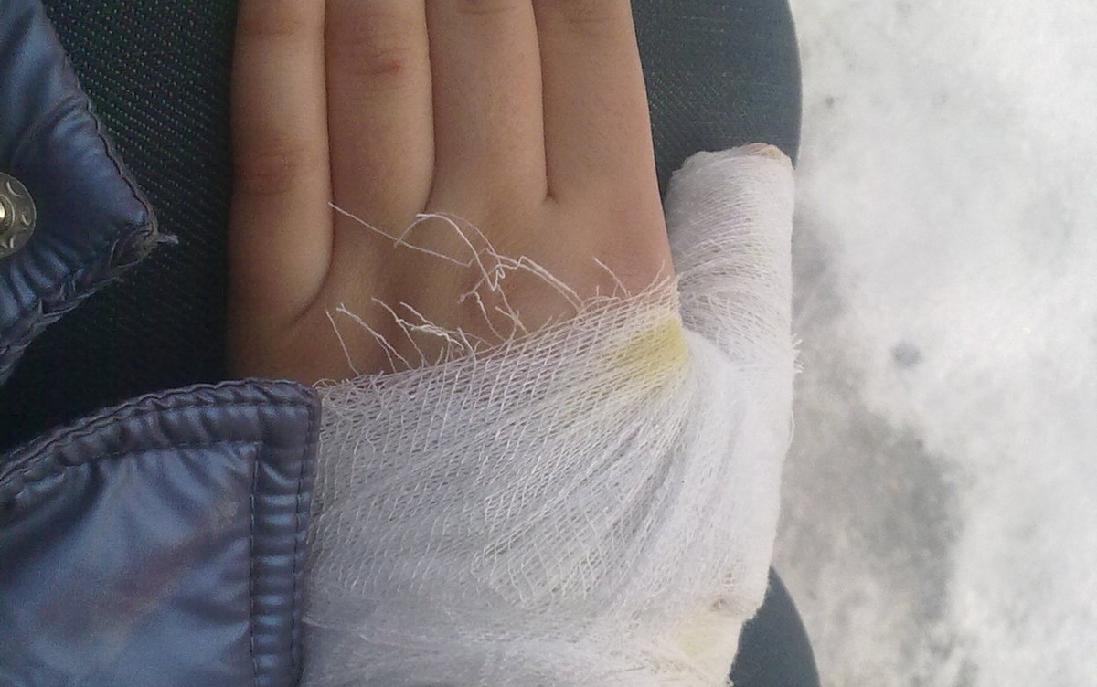    5 случаев обморожения зарегистрировали в Ижевске