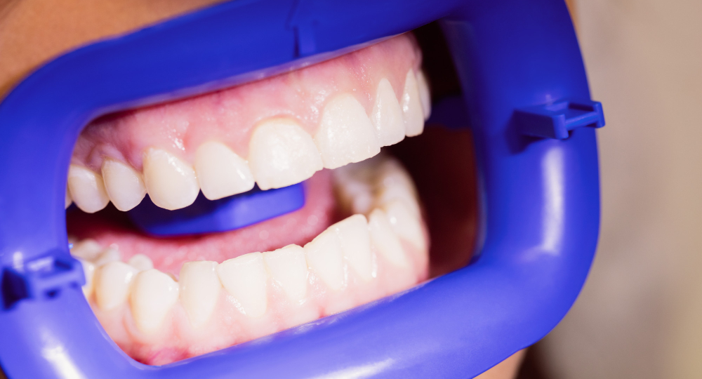 Коронка из диоксида циркония на свой зуб — и цирконий на весь фронт