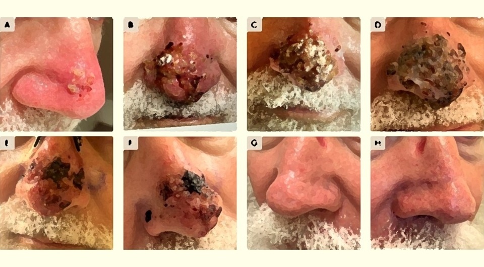   N + 1; Ricardo Villanueva Gaona et al. / BMJ Case Reports, 2025
