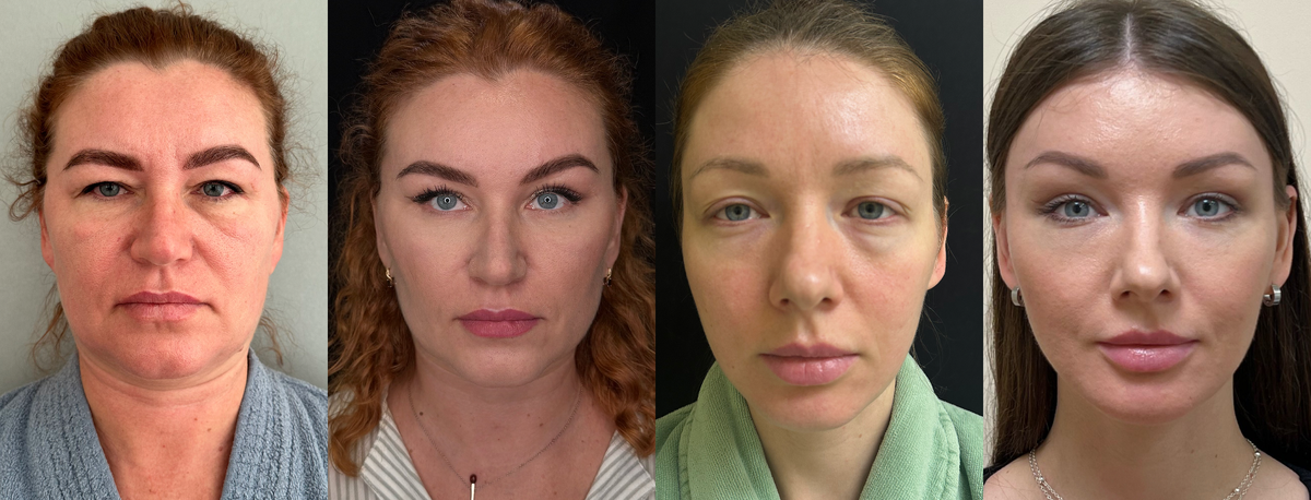 Эндоскопическая подтяжка верхней зоны лица 