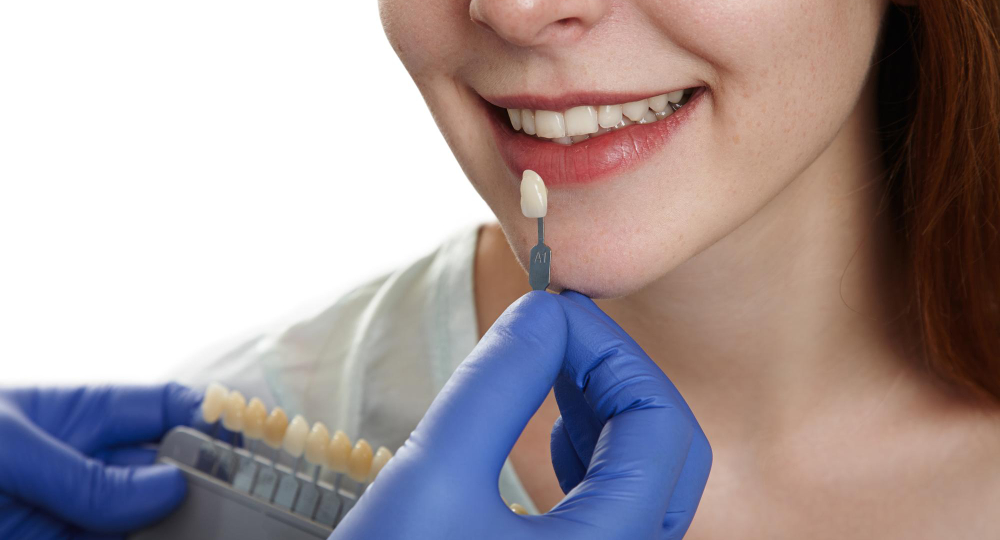Керамические виниры E‑max: и альтернативы, которые стоит знать