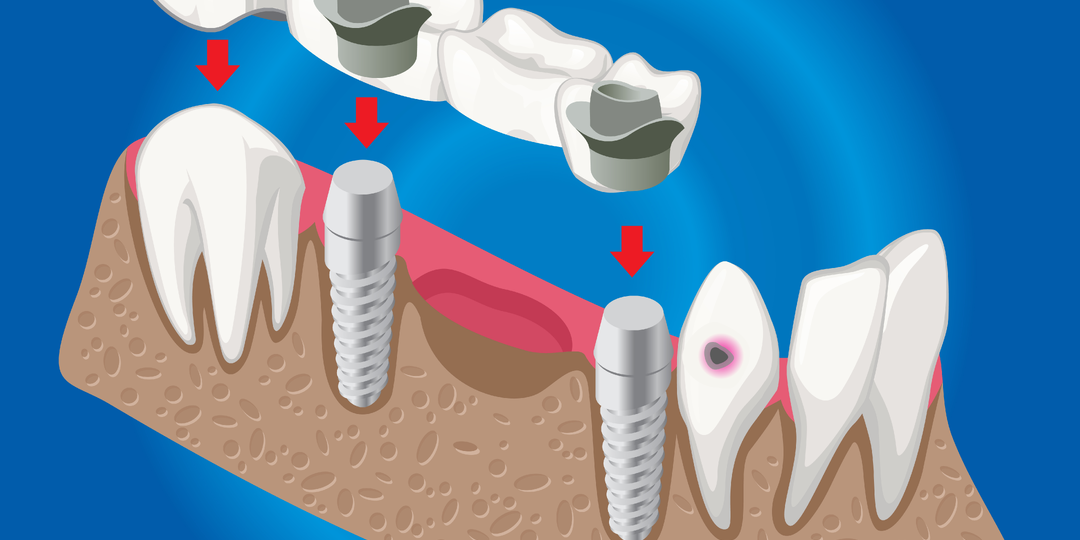 Как ставят мостовидный имплант и почему врач его предлагает: экономит или думает головой?