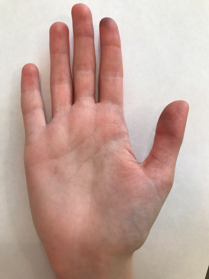 Слишком низкая посадка мизинца - его основание намного ниже оснований остальных пальцев. Яндекс-картинки. 