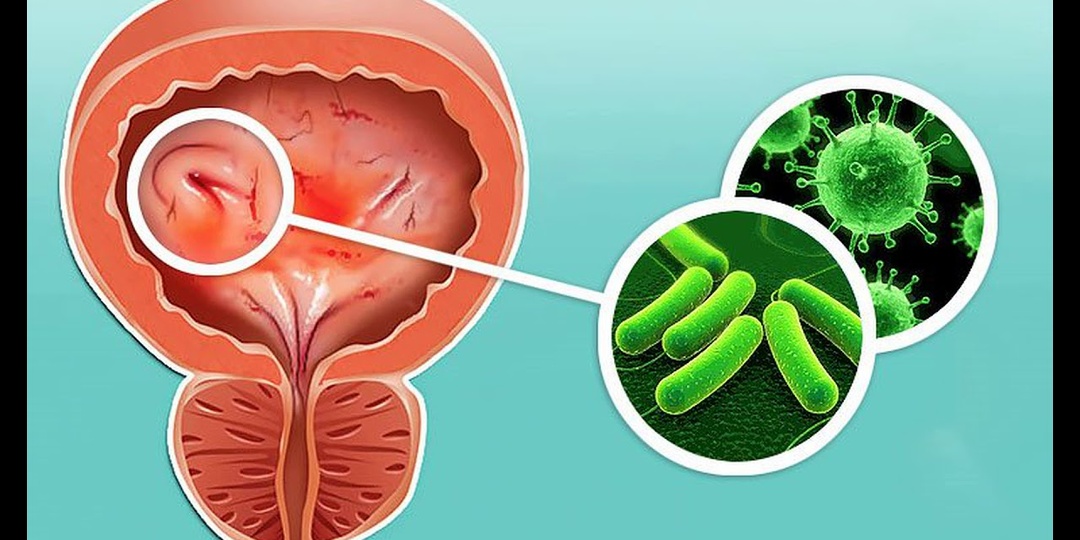 Причины Цистита у женщин: что запускает воспаление “на ровном месте”