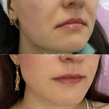 Результат нашего пациента ДО и ПОСЛЕ процедуры